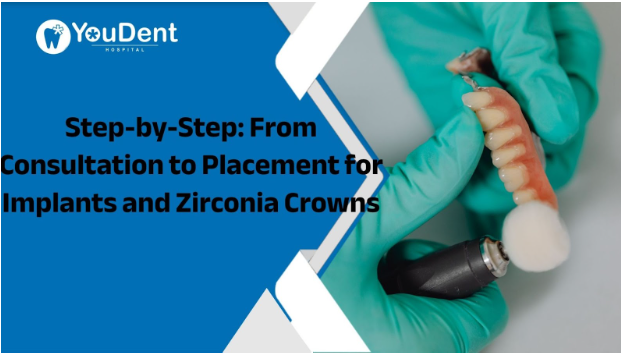 Step-by-Step: From Consultation to Placement for Implants and Zirconia Crowns